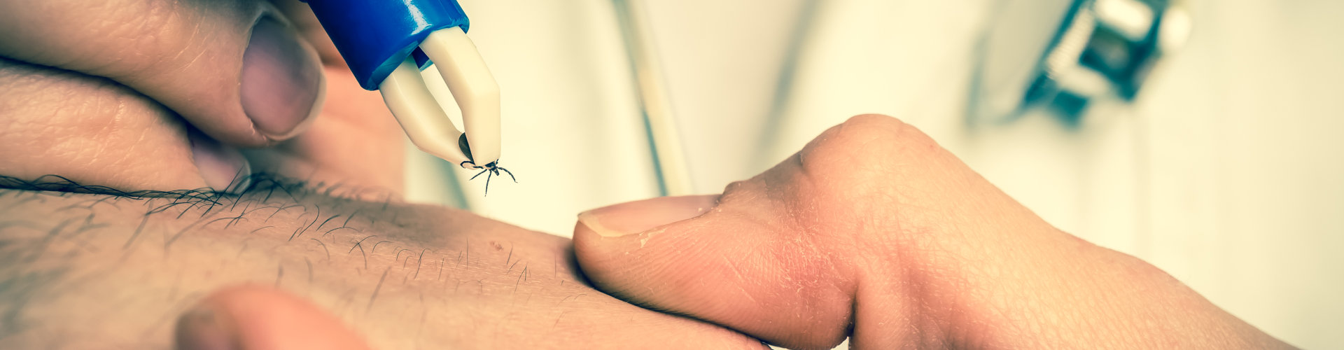 doctor removing a tick with tweezers from hand of patient